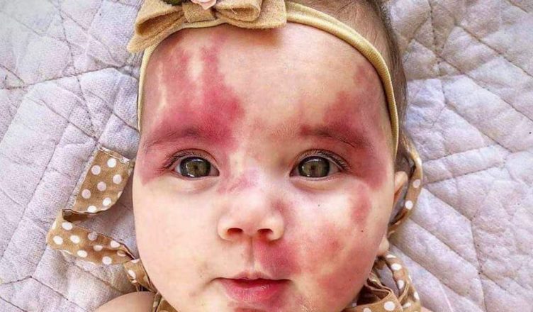 She Was Mocked for Her Face as a Baby But Now She Looks Totally Unrecognizable… Photos Here!