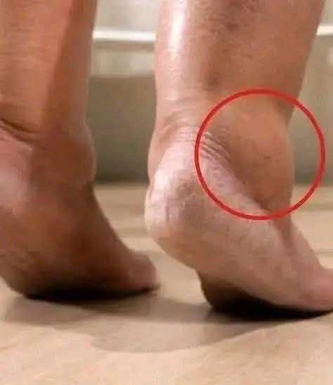 When Your Ankle Swells Up, It Could Mean More Than Just Tired Feet 